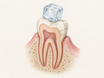 A molar cross-section shows an ice cube pressing on a cusp, producing fine hairline cracks in the enamel and stress at a filling edge, illustrating how chewing hard ice can damage tooth structure.