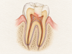 A cross-section of a molar with a composite filling close to the dental pulp, highlighting the nerve and surrounding gum tissue; subtle pink color in the pulp indicates possible post-filling sensitivity.