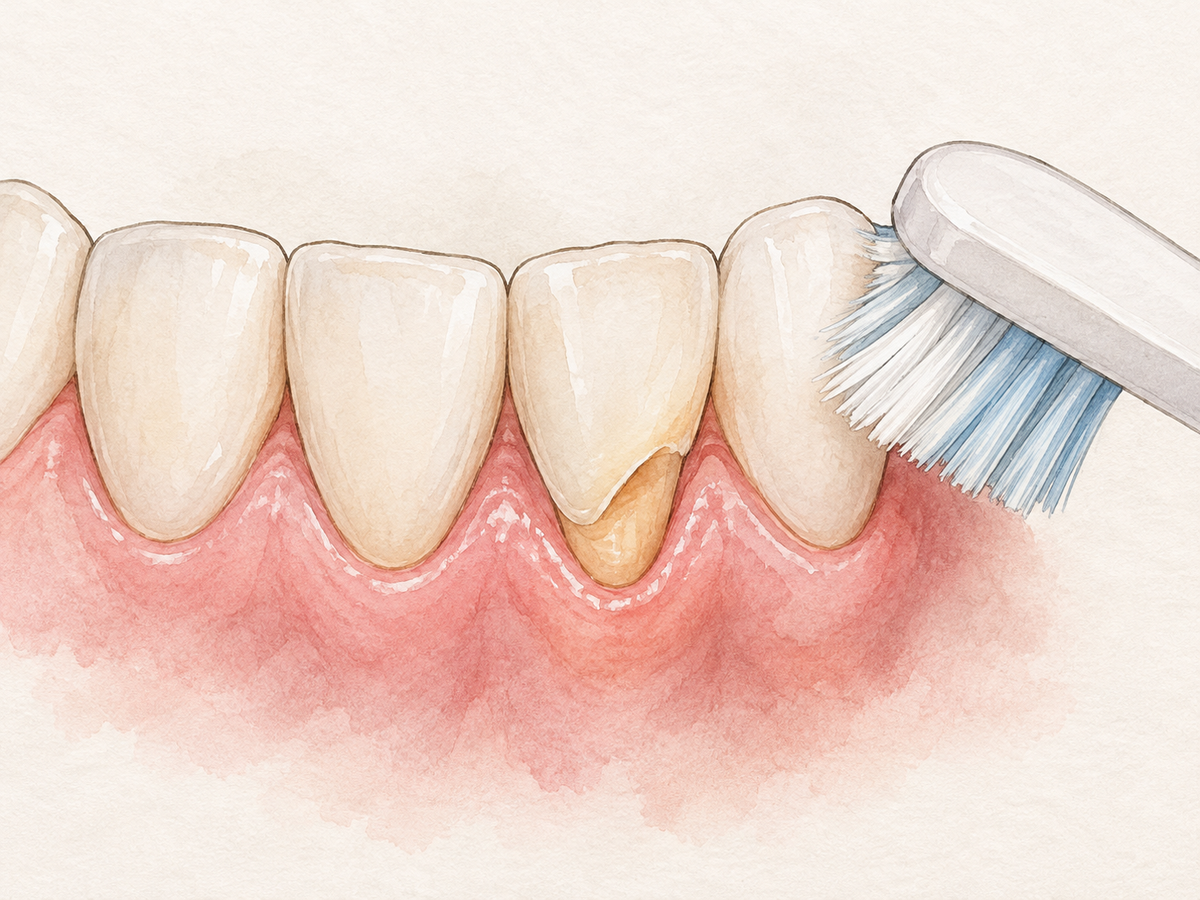 A lower front tooth in cross-section shows a wedge-shaped enamel wear notch at the gumline and receded gum exposing root, while soft toothbrush bristles rest lightly at the gumline to demonstrate gentler brushing.